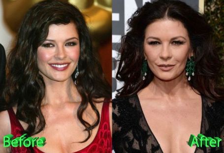 Before and After surgery images of Catherine Zeta-Jones.